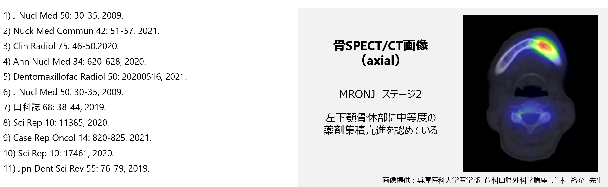 骨SPECT/CT画像(axialと関連文献)