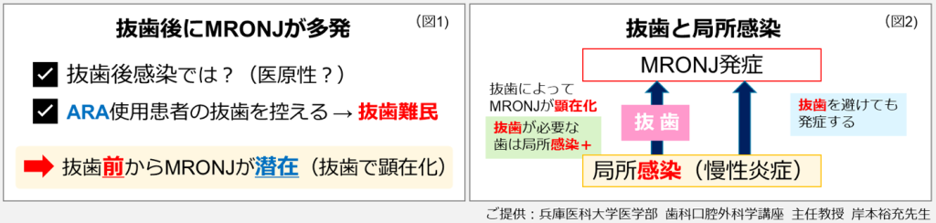 抜歯後にMRONJが多発、抜糸と局所感染