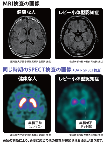 MRI検査・SPECT検査の画像