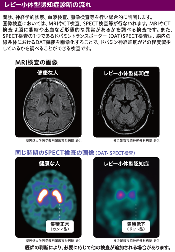 MRI検査の画像と同じ時期のSPECT検査の画像