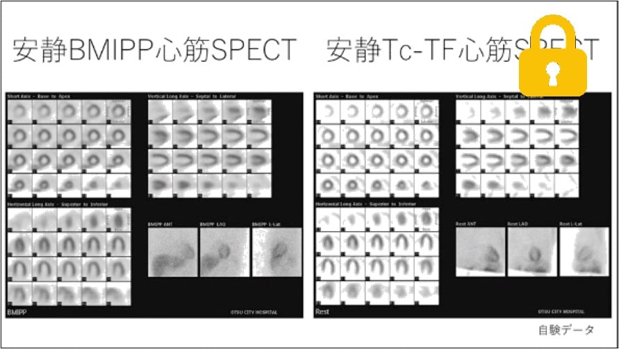 症例4～まとめ　50代男性(主訴：不整脈感)