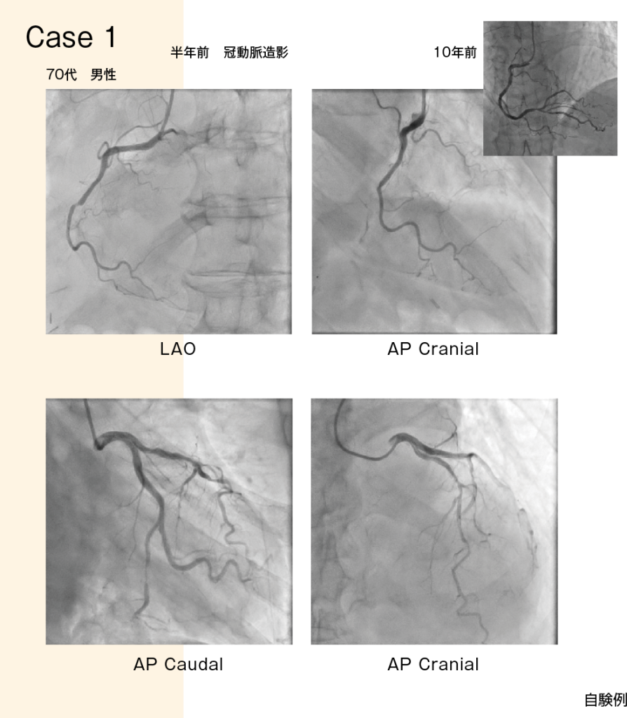 症例2 半年前 冠動脈造影 LAO,AP Cranial,AP Caudal,Ap Cranial