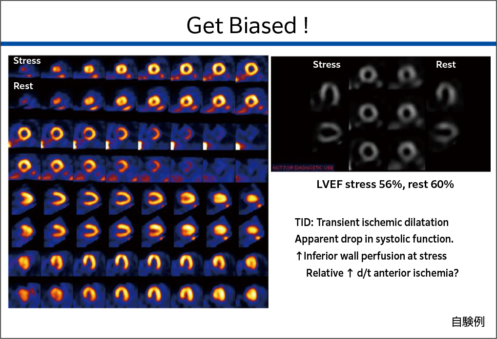 心筋SPECT画像:正常と判断できそうな自験例