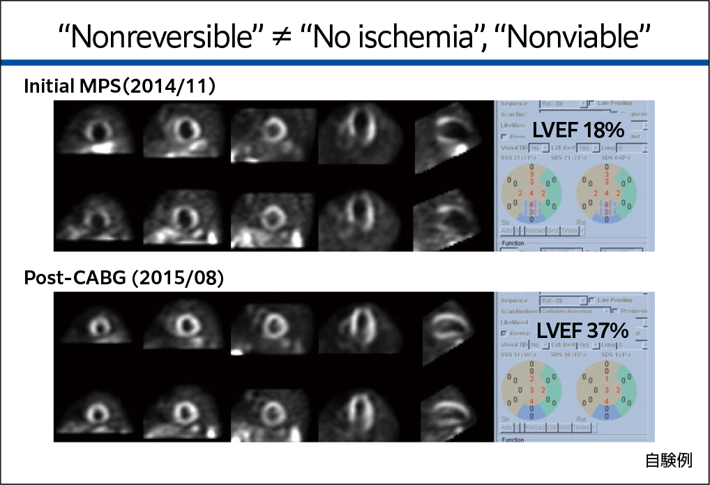 最初の心筋SPECT画像とCABG後の心筋SPECT画像