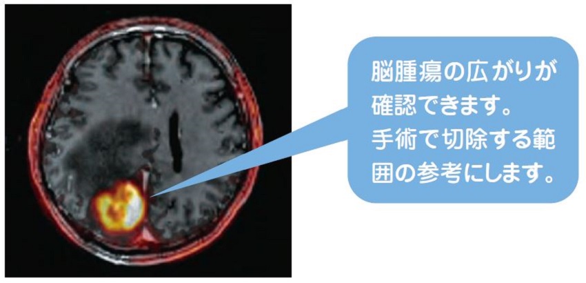 画像NMK36 第Ⅲ相臨床試験NMK36-BT-P302 試験より