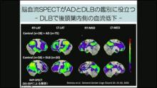 レビー小体型認知症(DLB)の鑑別診断の意義 サムネイル