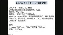 脳SPECT活用事例：DLB典型例,ADからの診断変更例 サムネイル